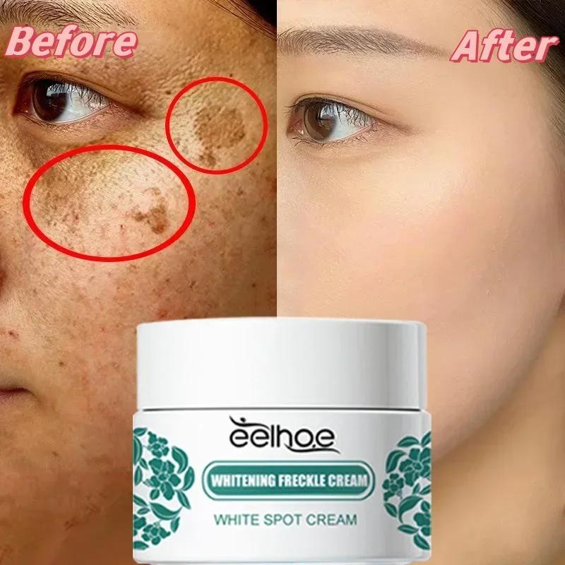 EELHOE-crema iluminadora Melasma de niacinamida, Reduce la melanina, ilumina la piel oscura, suero de Chloasma, desvanece las líneas finas de la cara